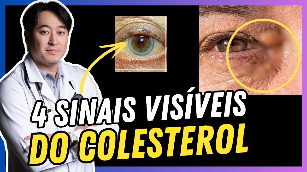 4 SINAIS DE COLESTEROL ALTO.