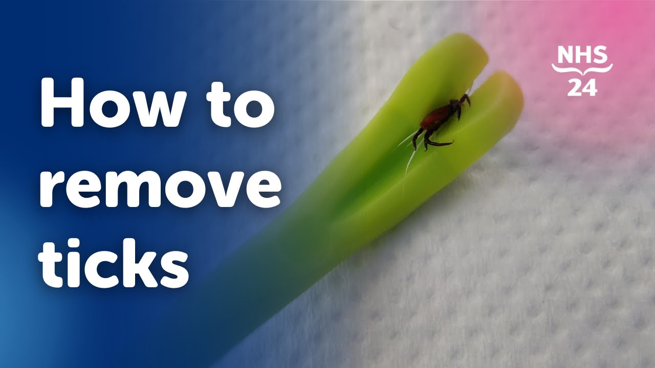 NHS Tick Removal Guide