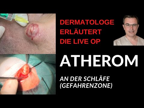 TALGZYSTE ENTFERNEN: Dermatologe Dr. Kasten zeigt die Entfernung einer Talgzyste an der Schläfe
