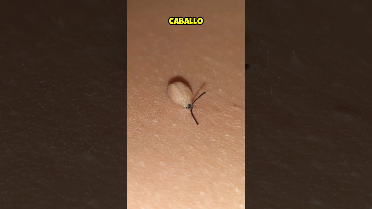 3 formas RÁPIDAS y FÁCILES de quitar ACROCORDONES o FIBROMAS BLANDOS