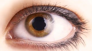 How to treat white bump on eye corner at home? - Dr. Nischal K