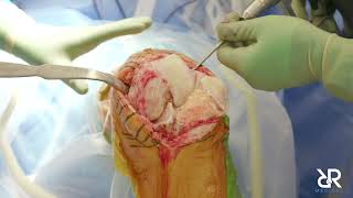 Dr. Stefan Kreuzer performs Total Knee Arthroplasty using the Think Surgical Robot: TCAT. (No Audio)