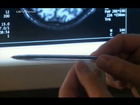 Kirurgjia e trurit - hyrje