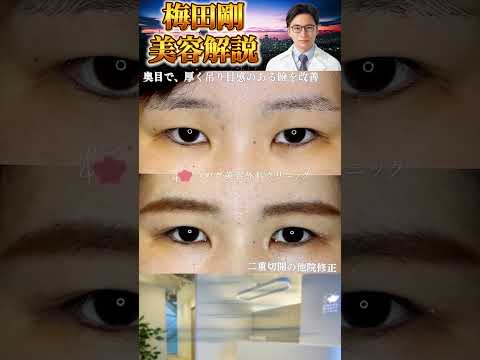 医学科 瞼が厚い患者様の他院修正　 #うめだ美容外科クリニック #眉下切開