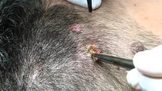 Eliminacion de Nevus Con Láser C02