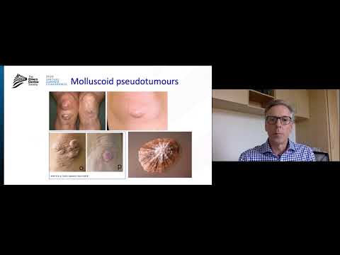 Virtual Summer Conference 2020: Manejo de Complicaciones en la Piel por el Dr. Nigel Burrows | Spanish (ES)