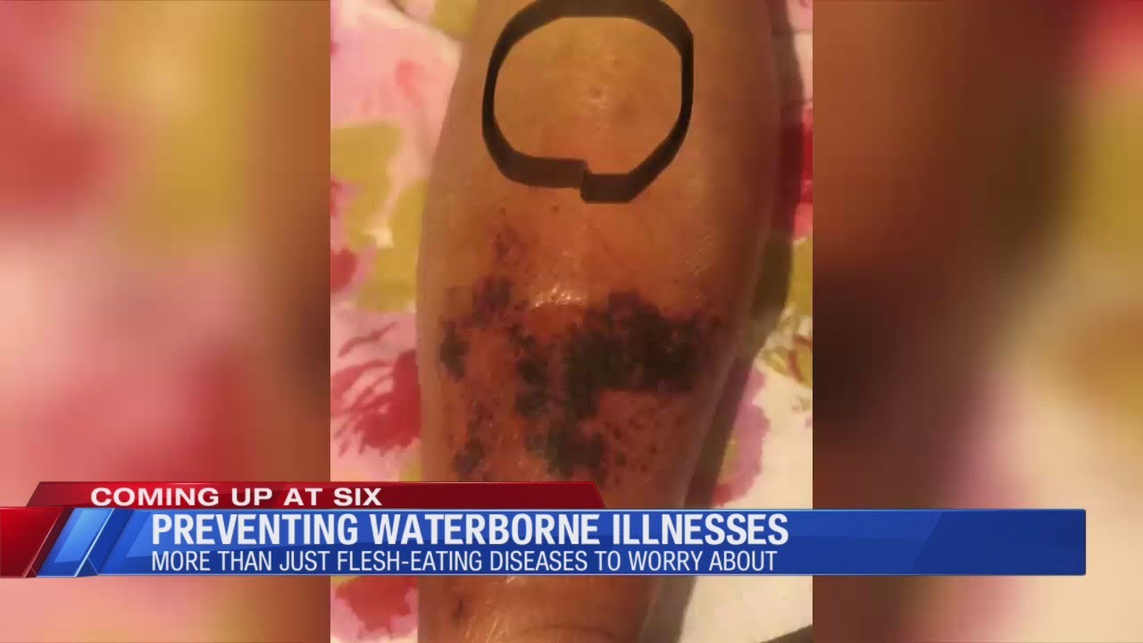 Preventing waterborne illness