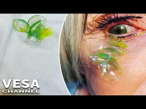 An elderly woman had 23 contact lenses removed from her eyeball