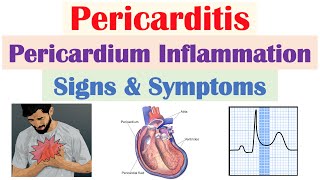 Pericarditis (Pericardial Inflammation) Signs & Symptoms (& Why They Occur)