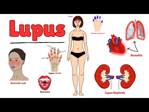 Systemic lupus erythematosus EXPLAINED Clearly!