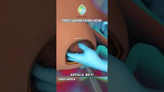 Download lagu Beginilah Proses Lahiran Caesar mp3