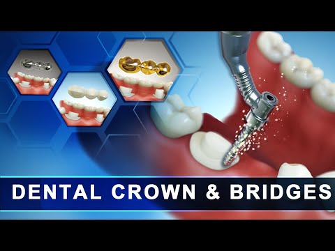 Dental Crown & Bridges | 3d Medical Animation