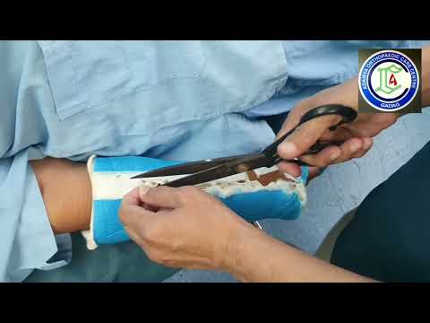 Geriatric fractures | Fracture Lower end Radius | Closed reduction | Ligamentotaxis | Adamya Hosp Vd