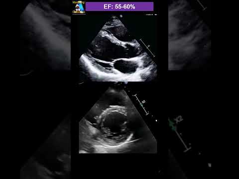 eyeball Guessing Ejection fraction
