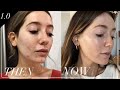 How I cured my hormonal, adult acne | skin series