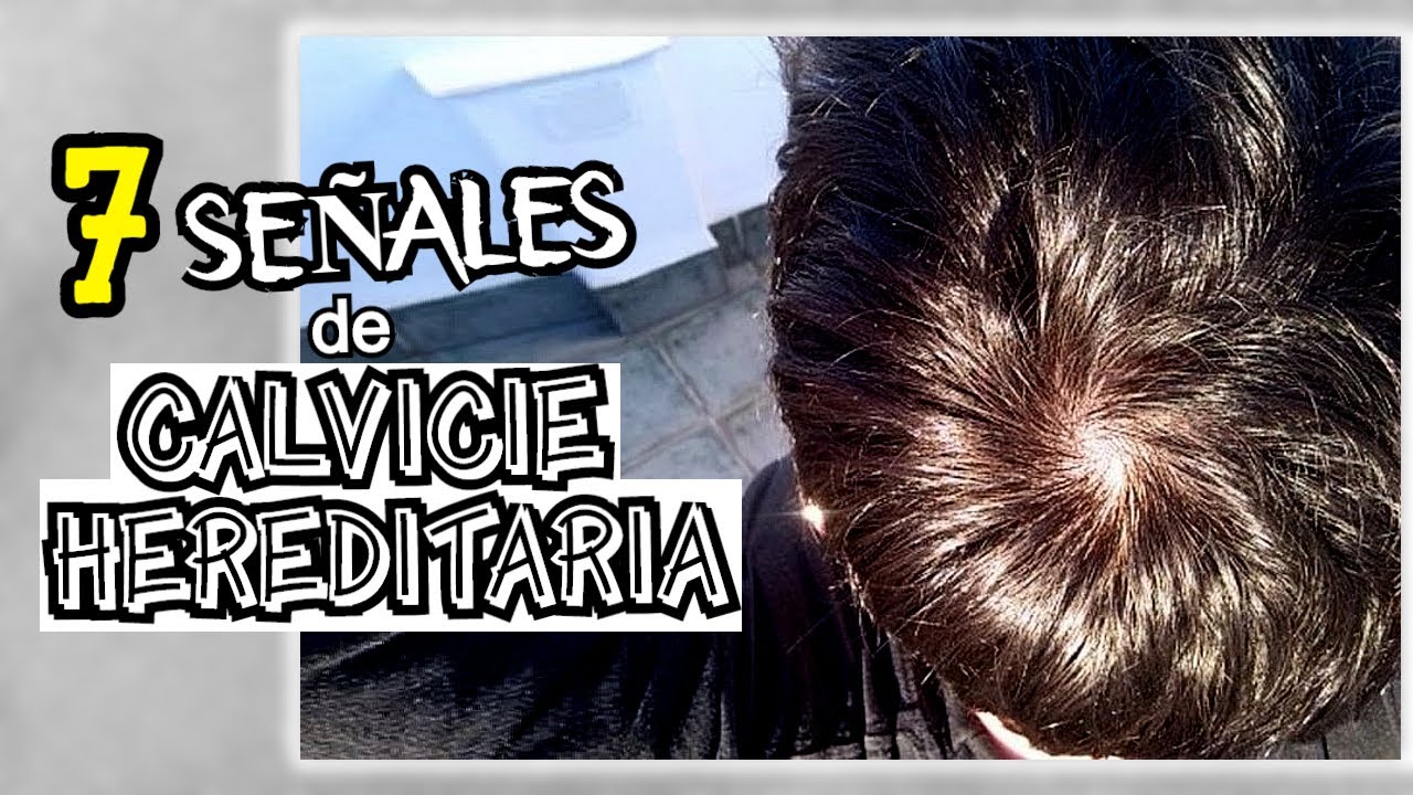 Cómo Saber Si Tienes Alopecia Genética (AGA o Calvicie Común) | Señales de Calvicie