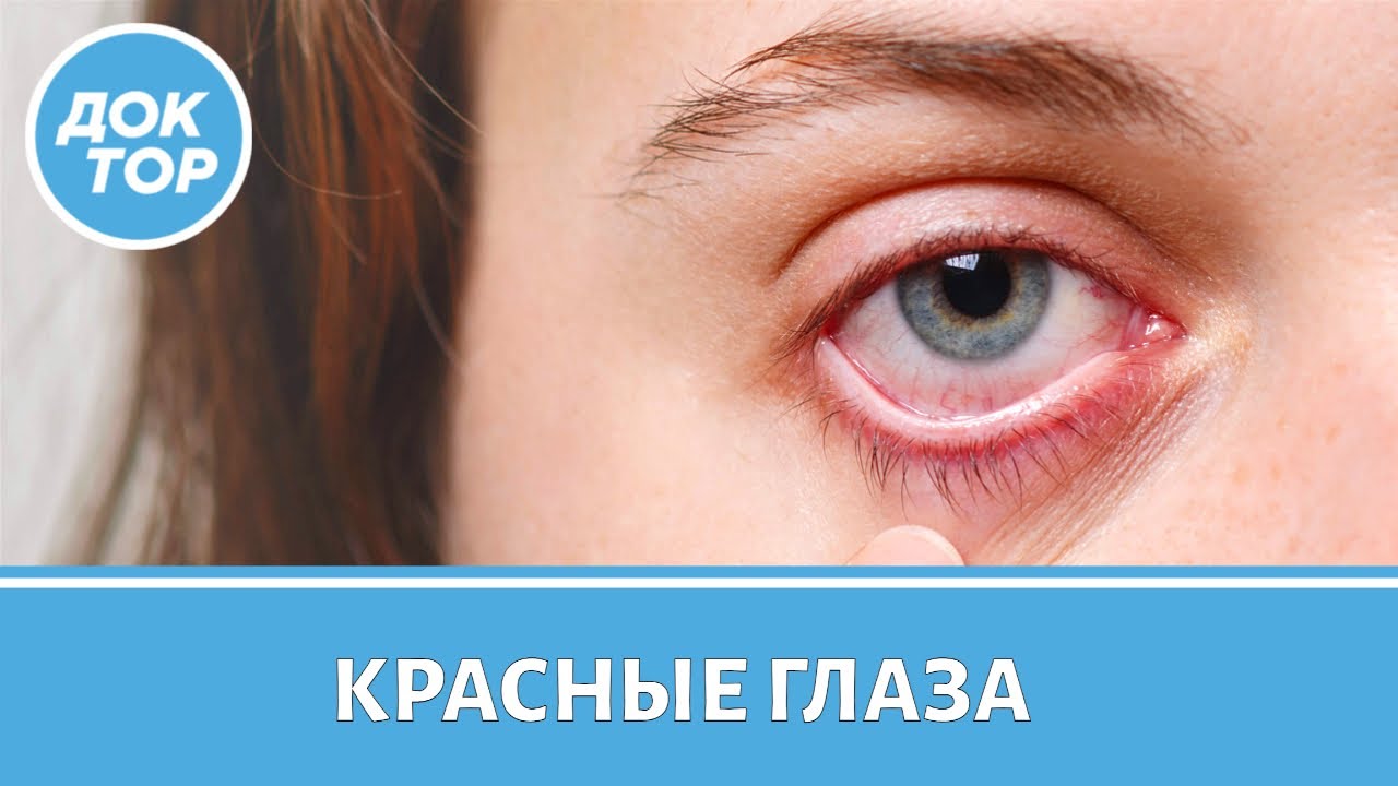 Какие серьезные заболевания скрываются за красными глазами