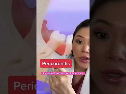 Pericoronitis. One of the reasons wisdom teeth have to come out. #wisdomteeth #dentist
