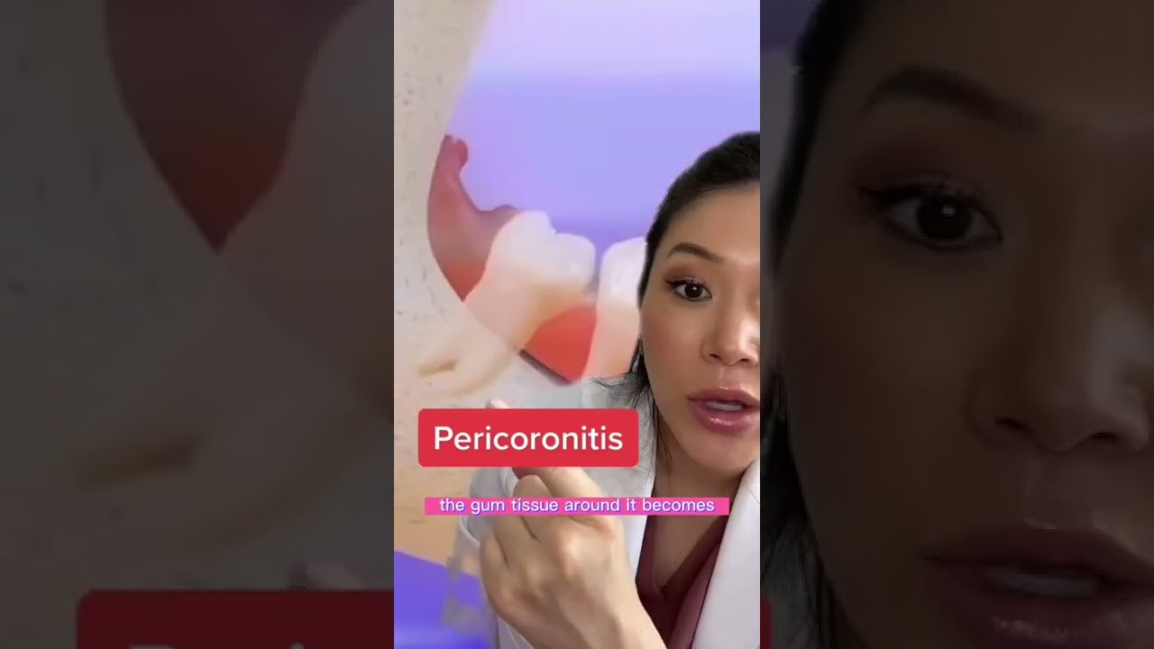 Pericoronitis. One of the reasons wisdom teeth have to come out. #wisdomteeth #dentist