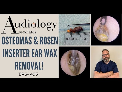 OSTEOMAS & ROSEN INSERTER EAR WAX REMOVAL - EP495