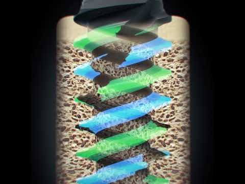 Straumann® BLX Implant System - Slim Osteotomy with Deep Threads Dynamic Bone Management