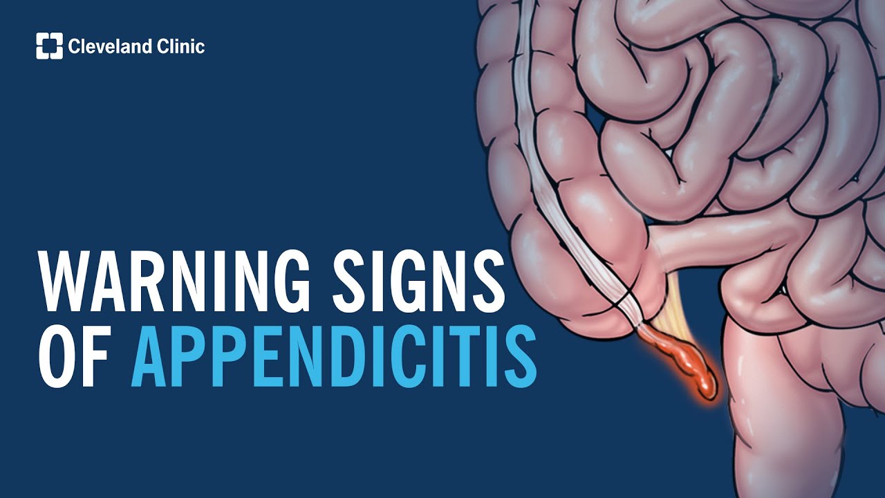 Warning Signs of Appendicitis