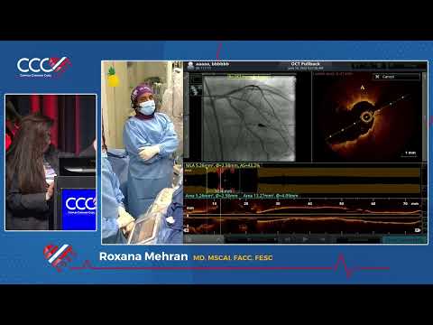 LIVE CASE  2 - Impella Assisted Distal LM Bifurcation Stenting with Mini-Crush Technique