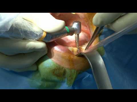 comment poser implanon