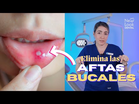 How to get rid of canker sores? Dr. Mailyn explains.