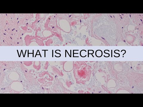 What is Necrosis? - Pathology mini tutorial