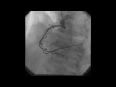 Acute vessel closure: differential diagnosis- Tarek Helmy, MD