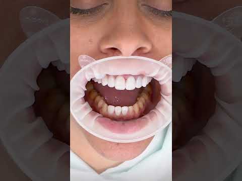 Unveil the Beauty of Your Smile with Zirconium Crowns and Laminate Veneers!