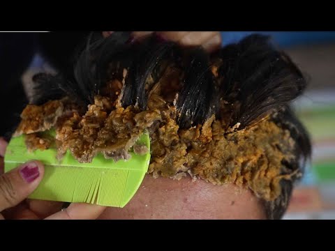 Omg Bad Flakes In Front Side !! Dandruff Removal Satisfying #407