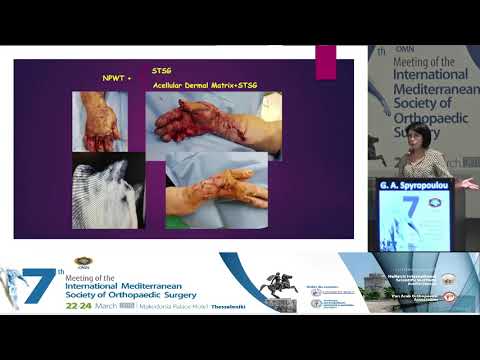 G A Spyropoulou - Treatment of the mangled hand injury. From a plastic surgeon perspective