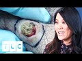 Dr Lee Squeezes A Cyst Through A Dilated Pore | Dr. Pimple Popper: This Is Zit Dr Lee Squeezes A Cyst Through A Dilated Pore | Dr. Pimple Popper: This Is Zit
