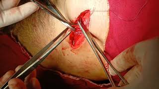 Open appendectomy procedure | step-by-step surgical Guide