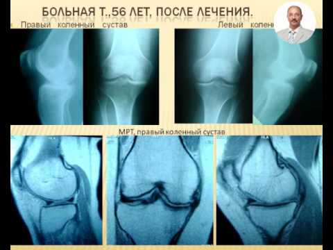 Кости и суставы в рентгеновском изображении купить Хруст в коленном суставе лечение в домашних условиях