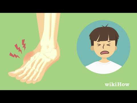 How to Tell if Your Foot Is Broken: 12 Steps (with Pictures)