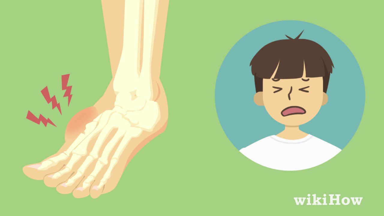 Watch How to Tell If Your Foot Is Broken Now How to Tell If Your Foot Is Broken