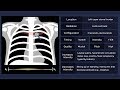 Pulmonary Flow Murmur