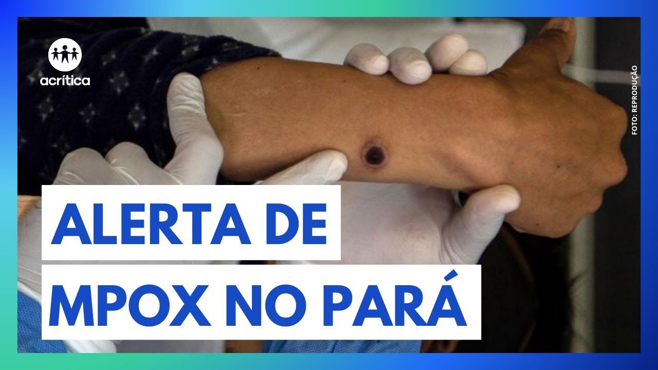 DOIS ÓBITOS POR MPOX SÃO REGISTRADOS NO ESTADO DO PARÁ