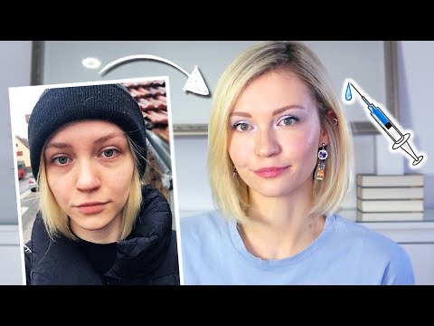 Getting Fillers For Dark Circles In Korea - My Experience, Costs & Longterm Results