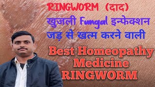 Homeopathic Ringworm Treatment Exposed दाद जड़ से खत्म