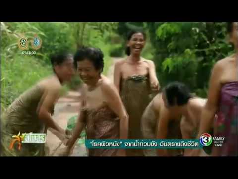 ในการควบคุมโรคสะเก็ดเงิน การรักษาฮอร์โมนของโรคสะเก็ดเงิน