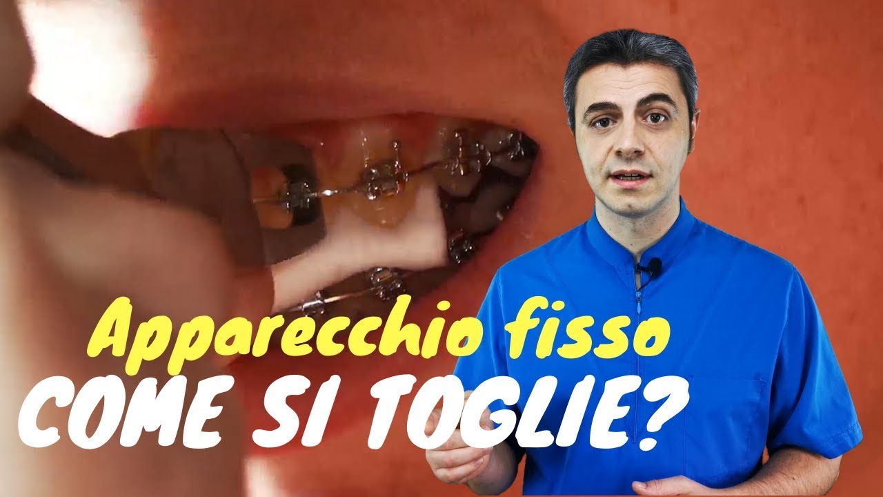Watch Now Come si toglie l'apparecchio fisso Come si toglie l'apparecchio fisso