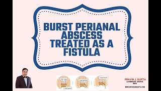 Download Lagu BURST PERIANAL ABSCESS SHOULD BE TREATED AS A FISTULA Thumbnail