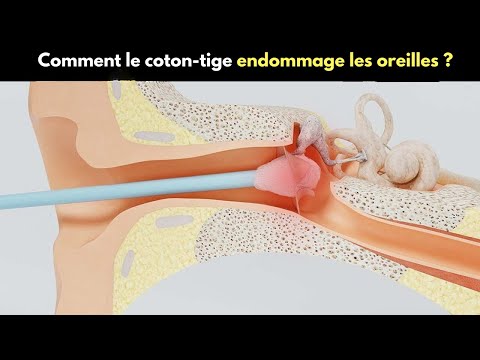 Comment le coton-tige endommage les oreilles ? | Les cotons-tiges sont-ils nocifs ?