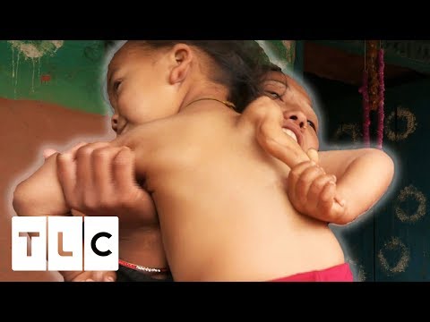 A boy with a third arm on his back (Body Bizarre season 4)