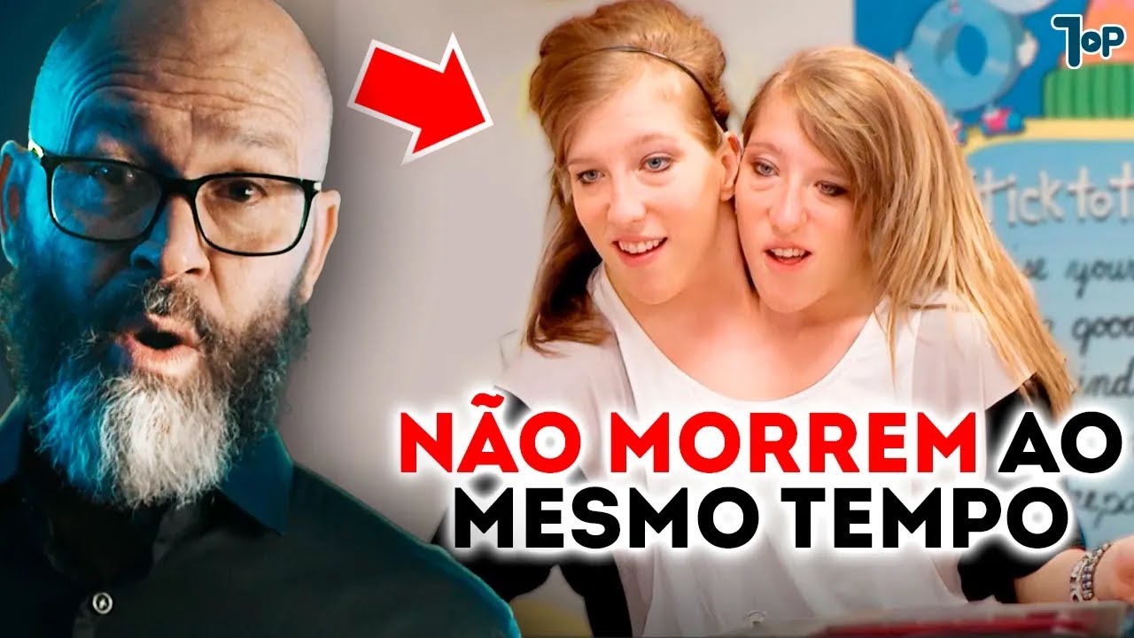 O que acontece se um gêmeo siamês morrer e o outro continuar vivendo?