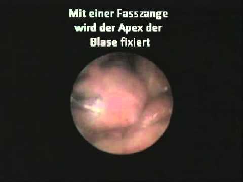 Behandlung von Prostatitis CMT Prostata-Massage-Finger beim Sex